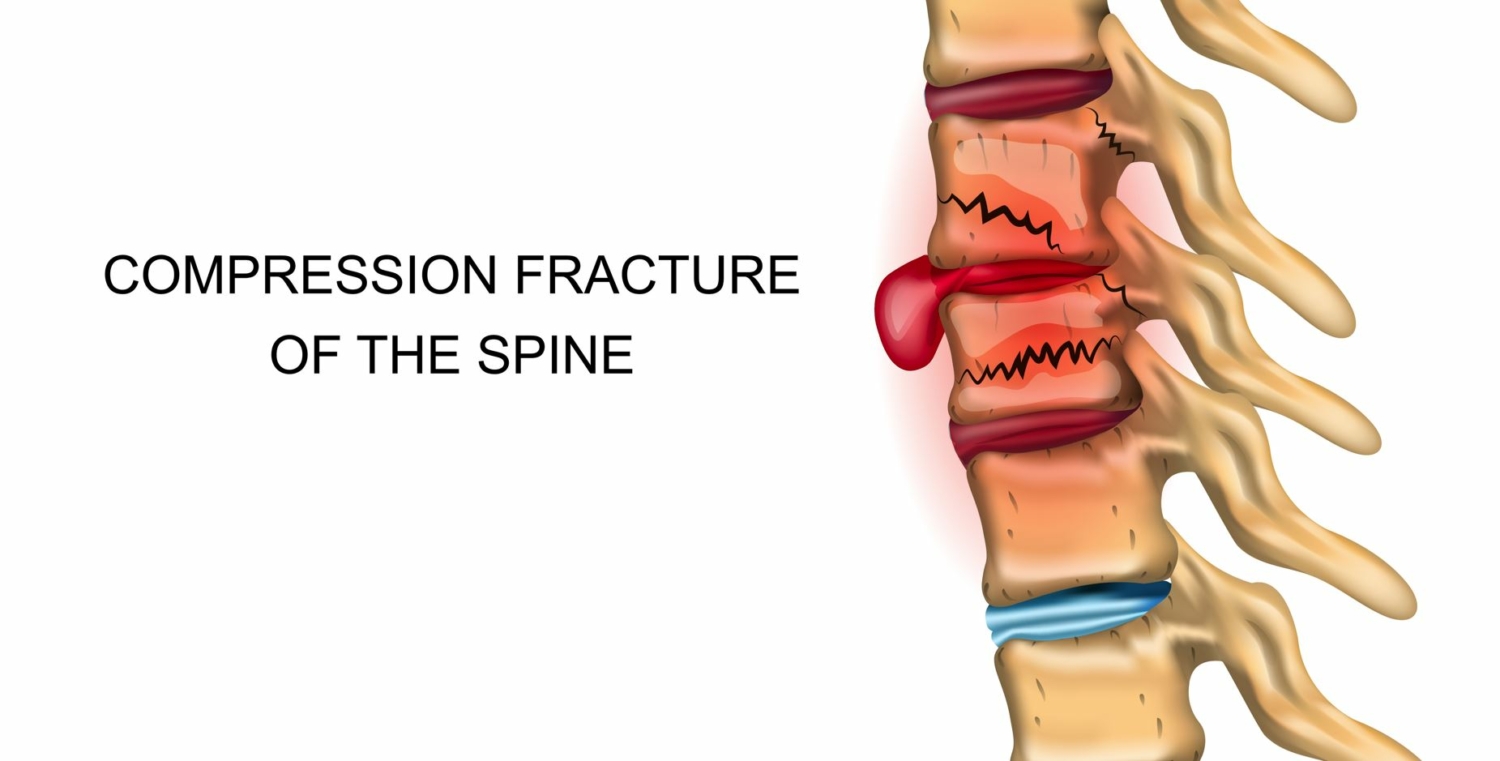 Can a car accident cause a spinal compression fracture? Nakase Law Firm